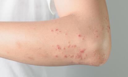 Ételek, amik allergis reakciót válthatnak ki Ételek, amik kiütést okozhatnak a bőrön