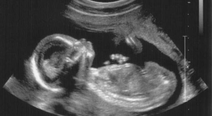 100 millió terhességből egyszer látnak ilyet az orvosok! A 23 éves Annabelle Williams-nek sikerült elkápráztatni az orvosokat, ugyanis 100 millió terhességből csak egyetlen egy ilyen! Szóval nagyon, nagyon ritka dolog történt... A cikk a kép alatt folytatódik!