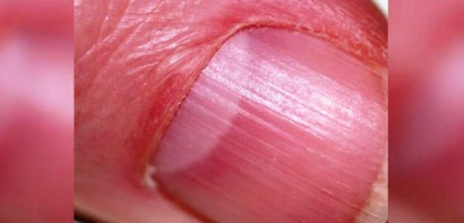 fungus alblikánok a körmökön hogyan kell kezelni egy nagy köröm láb gomba
