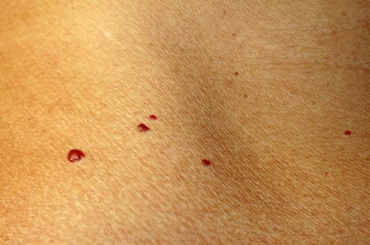 Piros foltok vannak a bőrödön? Elmondjuk, mit jelentenek! 