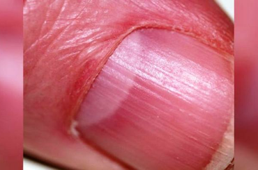 A körmödön lévő lunula (körömhold) elárulja az egészségi állapotodat!