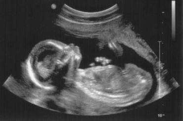 A 23 éves  Annabelle Williams-nek sikerült elkápráztatni az orvosokat, ugyanis 100 millió terhességből csak egyetlen egy ilyen! Szóval nagyon, nagyon ritka dolog történt... A cikk a kép alatt folytatódik!