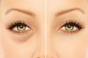 5 természetes orvosság a szem alatti sötét karikák ellen!