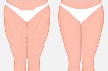 Így szabadulj meg a lógó bőrtől fogyás után