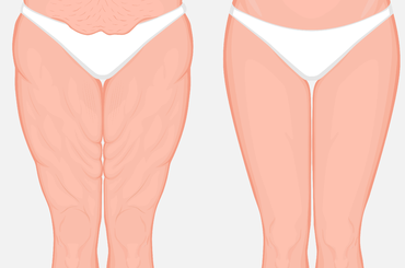 Fogyás a belső combokról