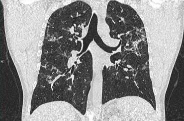 Még fél év után is kimutathatók CT-vel  a koronavírus okozta tüdőelváltozások