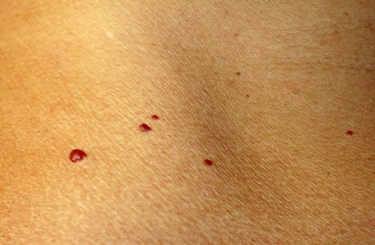 Piros foltok vannak a bőrödön? Elmondjuk, mit jelentenek! 