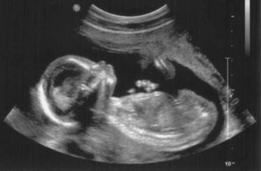 A 23 éves  Annabelle Williams-nek sikerült elkápráztatni az orvosokat, ugyanis 100 millió terhességből csak egyetlen egy ilyen! Szóval nagyon, nagyon ritka dolog történt... A cikk a kép alatt folytatódik!