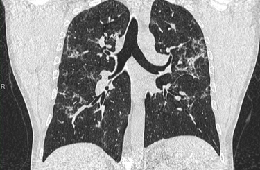 Még fél év után is kimutathatók CT-vel  a koronavírus okozta tüdőelváltozások