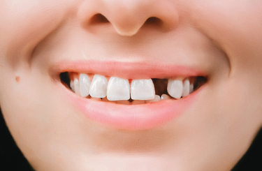 Foglepedék káros hatása