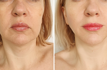 Szálbehúzás tudnivalók